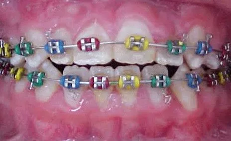 Brackets de colores