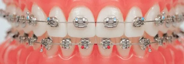 Brackets de colores