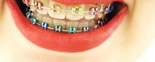 Brackets de colores