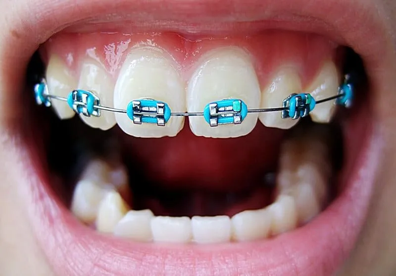 Brackets de colores