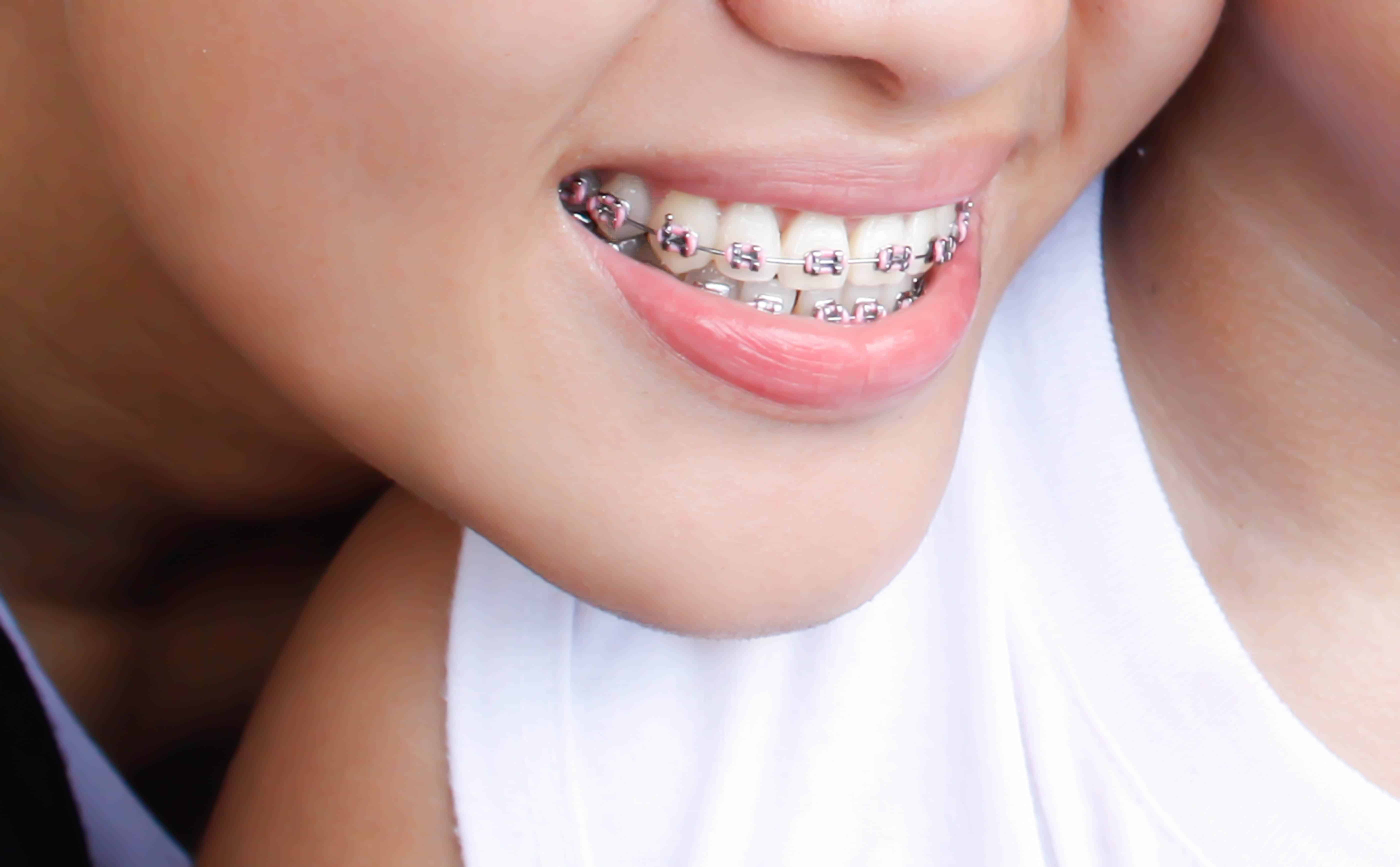 Como elegir el color de los brackets