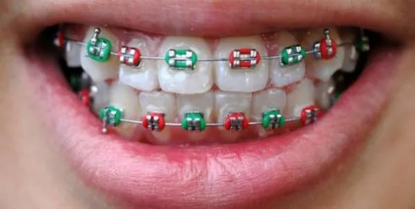 Brackets de colores para hombre - Imagui