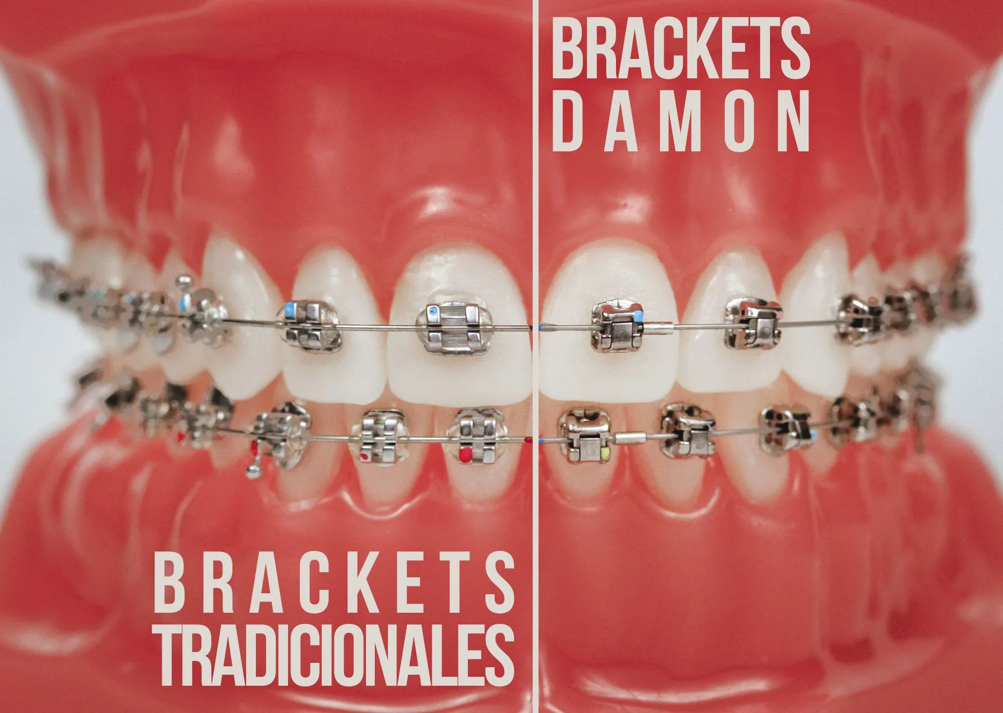 Brackets Damon, mayor comodidad, resultados más rápidos | BLOG DE ...