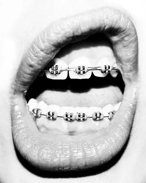 Sonrisas con brackets tumblr - Imagui