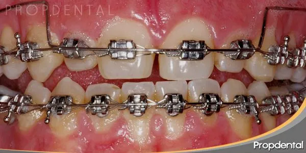 Imagenes brackets metalicos de colores - Imagui