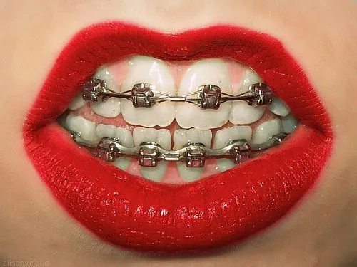 Brackets on Pinterest | Braces, Braces Colors and Fake Braces Brackets on Pinterest | Braces, Braces Colors and Fake Braces