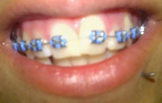 Mis Brackets: Paso a Paso [Mi experiencia]: abril 2014