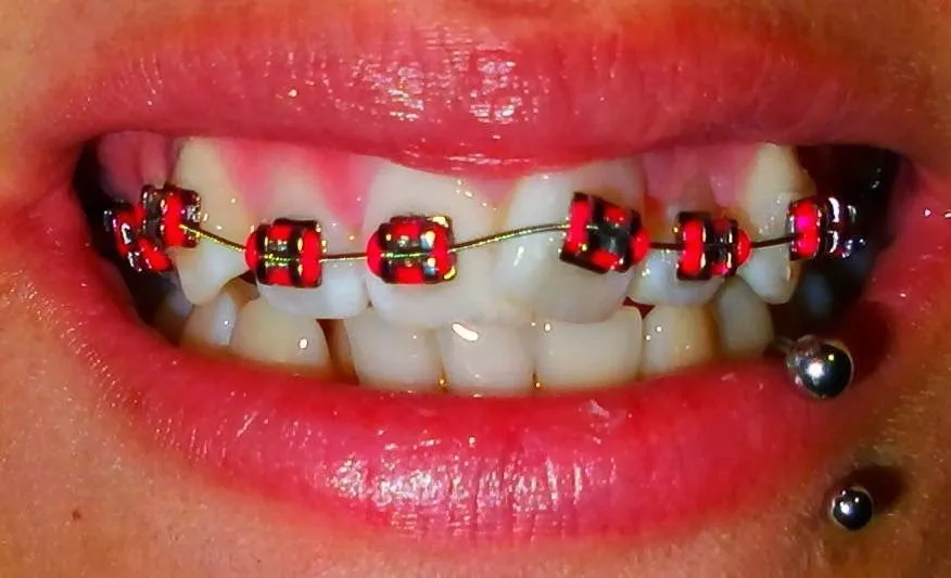 Mis Brackets: Paso a Paso [Mi experiencia]: febrero 2014