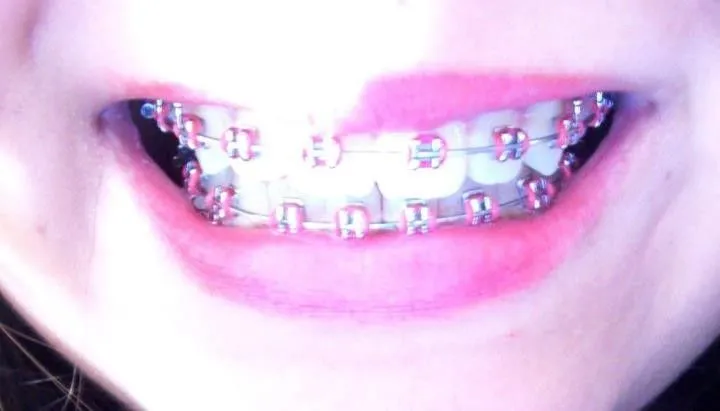 Brackets rosas - Imagui