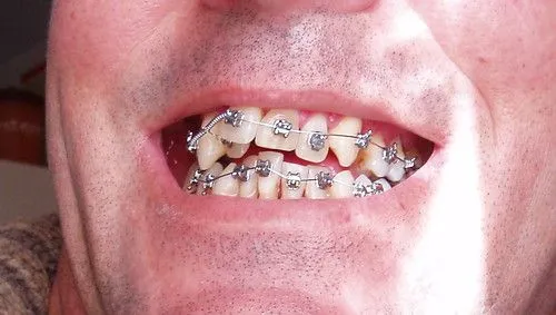Brackets rosas - Imagui