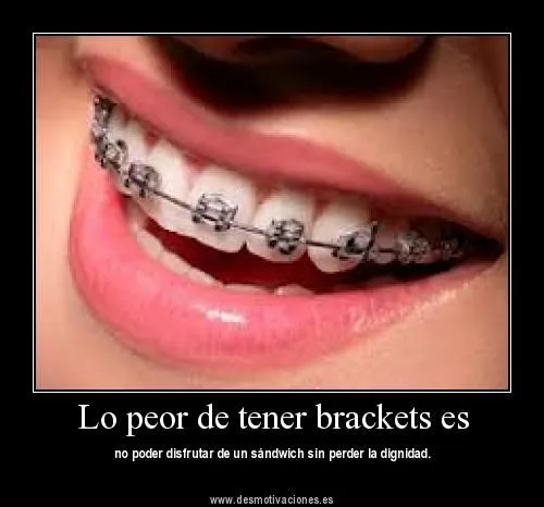 Brackets transparentes estéticos ~ Vida Blogger