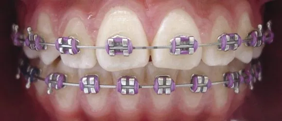 Brackets transparentes estéticos ~ Vida Blogger