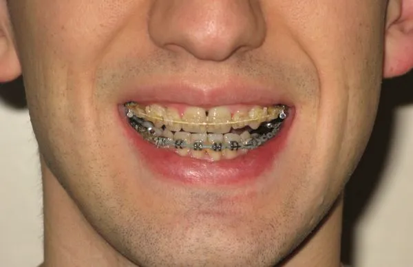 brekets: Скоро снимать!