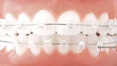 Брекеты. Лингвальная брекет система и ее цена. Установка брекетов ...