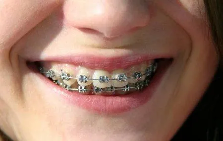 Hay cambios de color en los dientes luego de utilizar brackets ... Hay cambios de color en los dientes luego de utilizar brackets ...