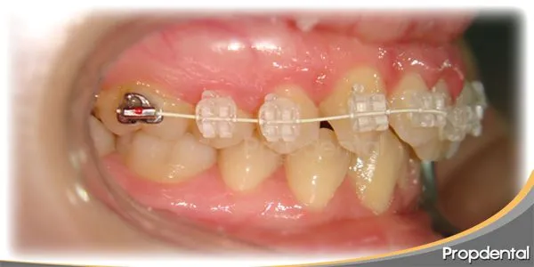 Caso clínico brackets de zafiro | Ortodoncia estética Caso clínico brackets de zafiro | Ortodoncia estética