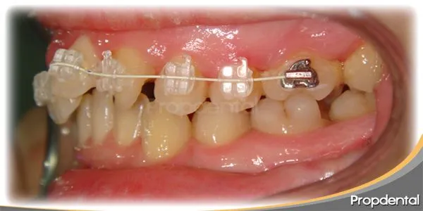 Caso clínico brackets de zafiro | Ortodoncia estética