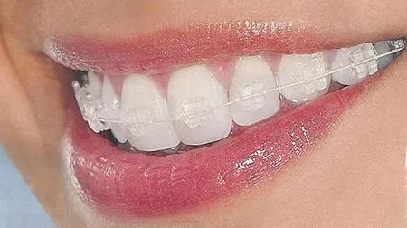 Brackets tipos de ligas - Imagui