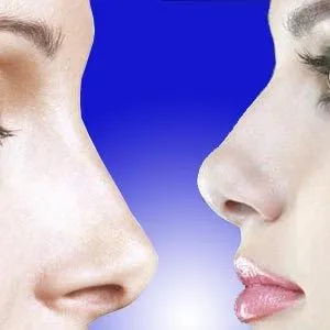 Cien por cien bella: Cirugia de nariz: Rinoplastia Cien por cien bella: Cirugia de nariz: Rinoplastia