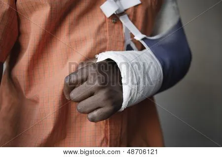 Closeup torso de un hombre con el brazo enyesado Fotos stock e ...