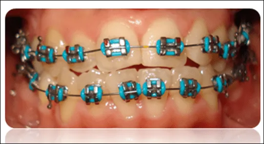 Los mejores colores de ligas para brackets - Imagui