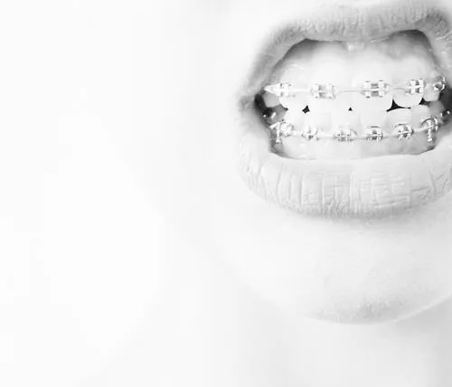de que color me pongo los brackets?