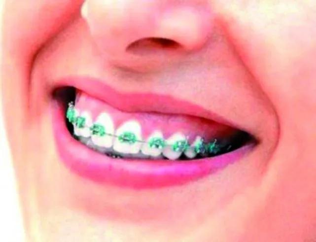 Colores de brackets de moda 2014 - Imagui