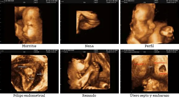 Conoce las ECOgrafias 3D y 4D ~ el paciente y tú Conoce las ECOgrafias 3D y 4D ~ el paciente y tú