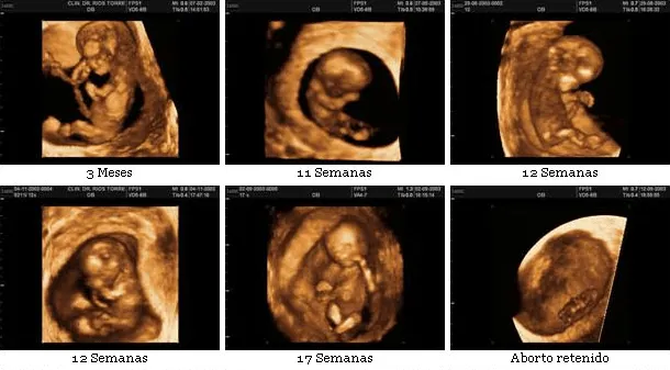 Conoce las ECOgrafias 3D y 4D ~ el paciente y tú Conoce las ECOgrafias 3D y 4D ~ el paciente y tú