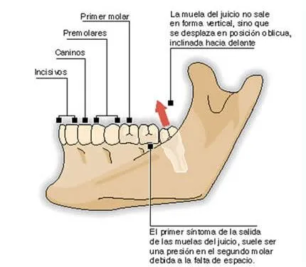Por qué crecen las muelas del juicio? | POR QUÉ, CÓMO Y DÓNDE
