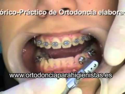 demo colocacion brackets.mp4 - YouTube