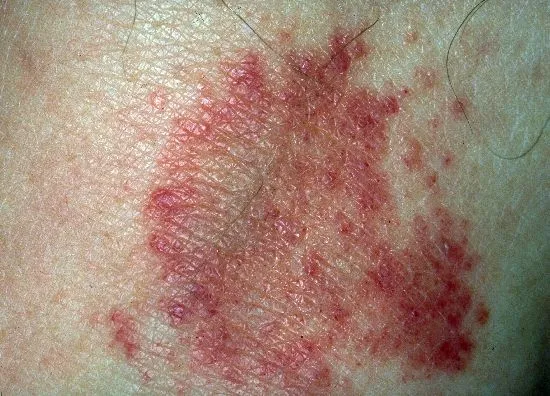 DermIS - Purpura Annularis Telangiectodes Majocchi (image)