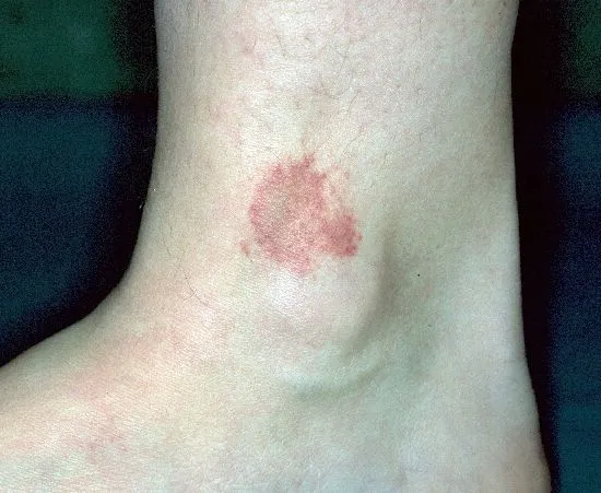 DermIS - Purpura Annularis Telangiectodes Majocchi (image)
