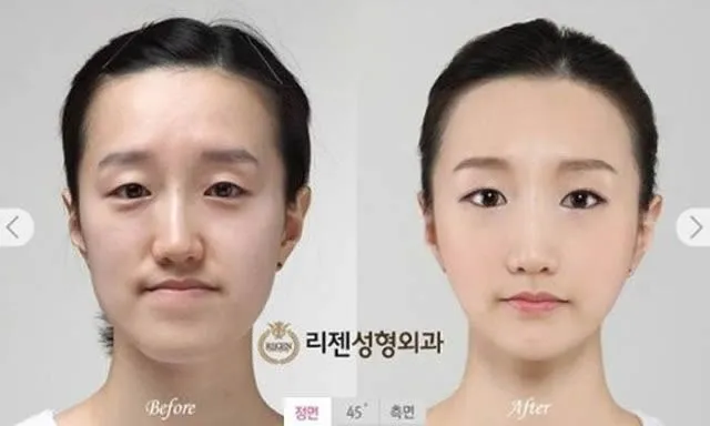 El antes y después: cirugía plástica en Corea 2 | Marcianos El antes y después: cirugía plástica en Corea 2 | Marcianos