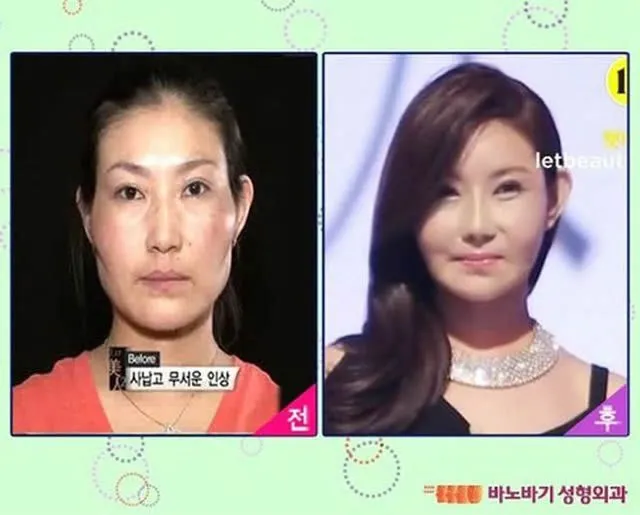 El antes y después: cirugía plástica en Corea 2 | Marcianos El antes y después: cirugía plástica en Corea 2 | Marcianos