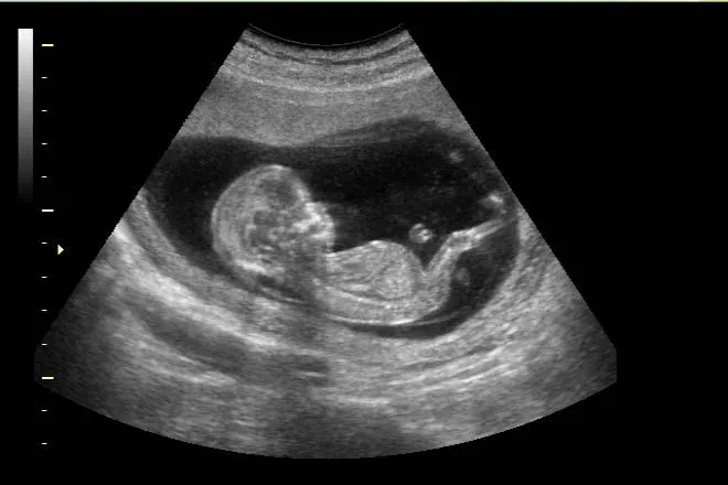 DETECCION ECOGRAFICA Y PRONÓSTICO DE LA VENTRICULOMEGALIA FETAL ...