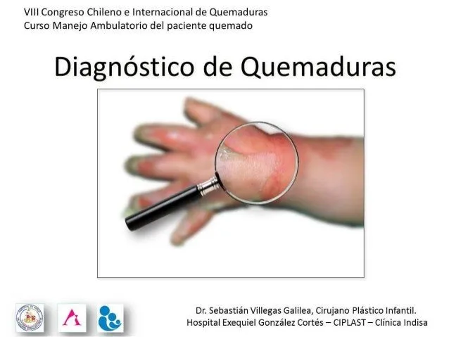 Diagnóstico de quemaduras en niños, adultos y en la tercera edad Diagnóstico de quemaduras en niños, adultos y en la tercera edad