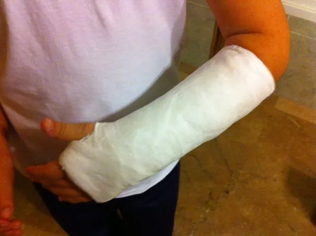 Diario de una mamá pediatra: Fracturas de antebrazo: las más ... Diario de una mamá pediatra: Fracturas de antebrazo: las más ...