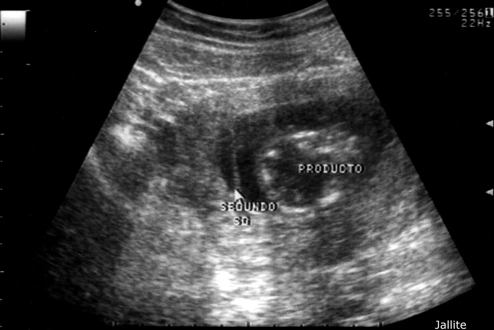 Diario de un Medico II: Gemelo Evanescente