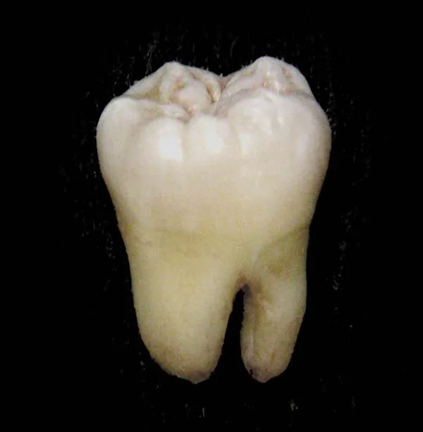 Molar (tooth) - Wikipedia, the free encyclopedia