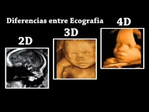 Diferencias entre ecografia 4D, 3D y 2D