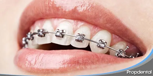 Cuáles son los distintos tipos de brackets dentales?