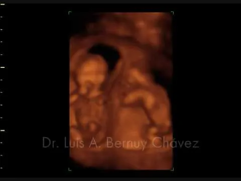 Dr. Luis A. Bernuy Chávez - Ecografía 4D: Gemelos - YouTube