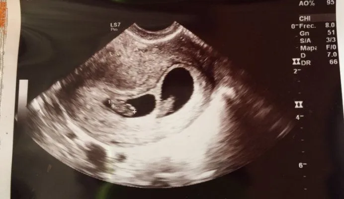 Duda - Mellizos o gemelos - BabyCenter