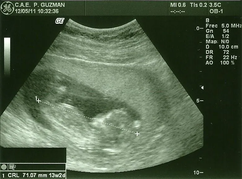 Ecografías de 12 semanas niño o niña - Imagui