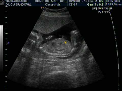 Foto ecografia niña 16 semanas - Imagui