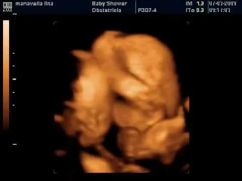 Eco 4D de gemelos - Demian y Tiziano 22,2 semanas - YouTube Eco 4D de gemelos - Demian y Tiziano 22,2 semanas - YouTube