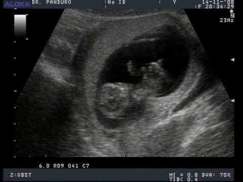 eco de mi bebe a las 11 semanas :)!! - YouTube