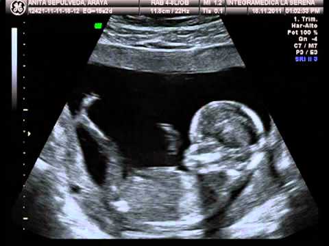 eco de mi bebe a las 15 semanas - YouTube