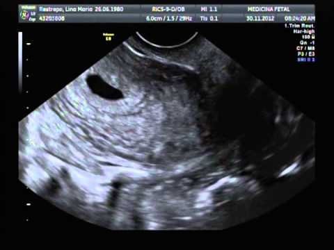 Eco embarazo de 6 semanas - Imagui